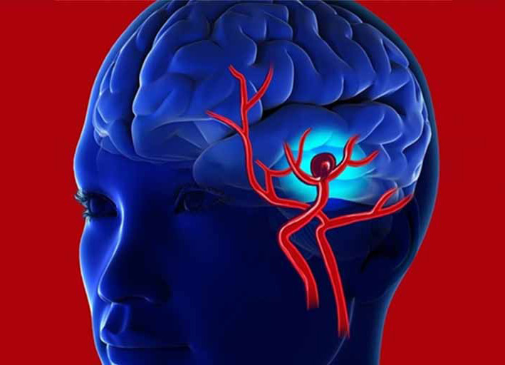 Brain aneurysm2