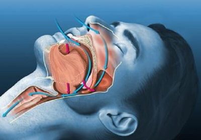 درمان آپنه خواب